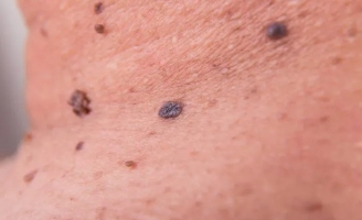 Ba 'đen' trên cơ thể cảnh báo nguy cơ ung thư